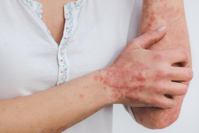 psoriasis-5996424_640
